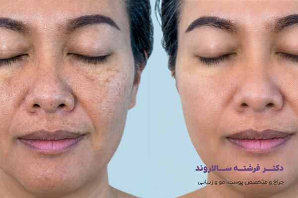 اندولیفت صورت چیست و چگونه عمل میکند؟