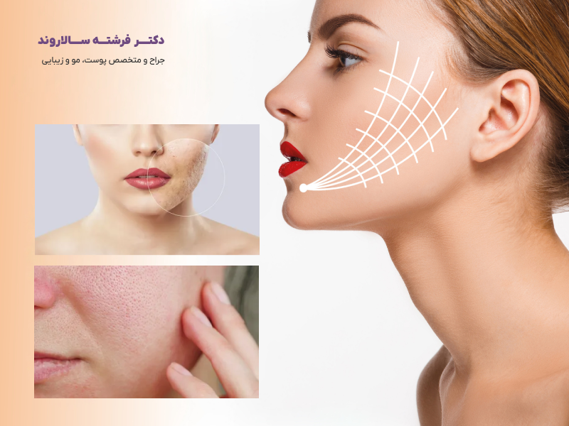 اندولیفت صورت؛ روشی مدرن برای جوانسازی پوست