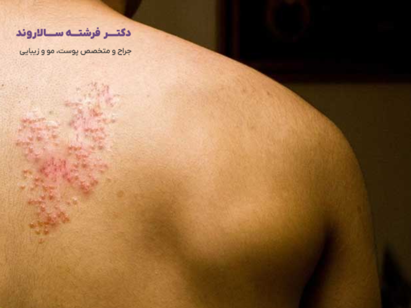 انواع بیماری های پوستی