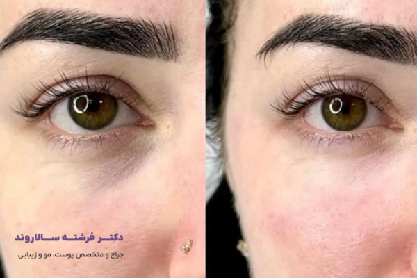 تزریق فیلر در زیر چشم