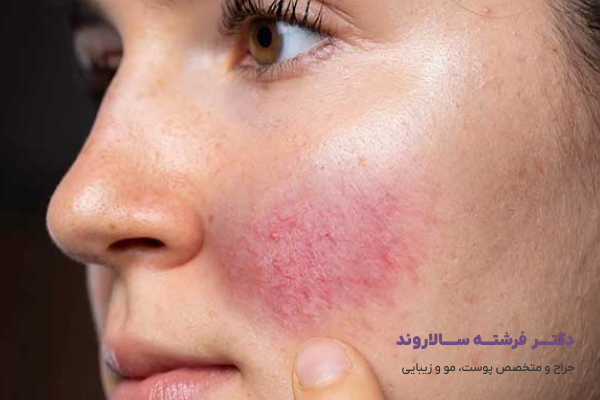 روزاسه