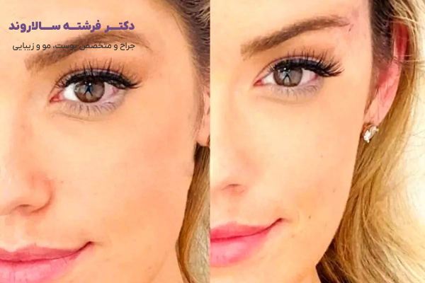 لیفت چشم و ابرو با بوتاکس چیست؟