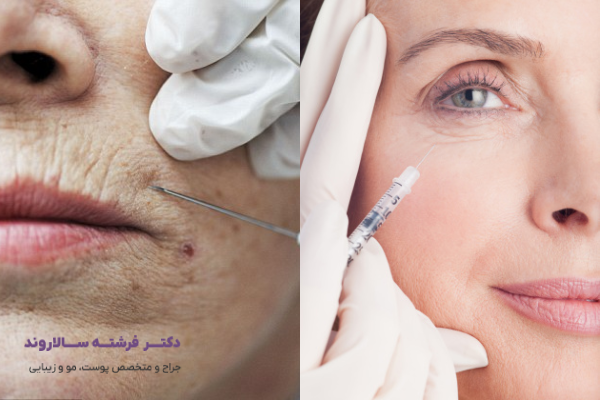 مزایای تزریق فیلر چیست؟