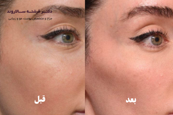 کاربرد تزریق فیلر در گونه ها