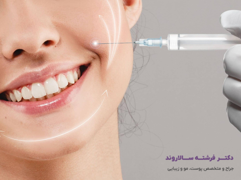 تزریق فیلر خط خنده