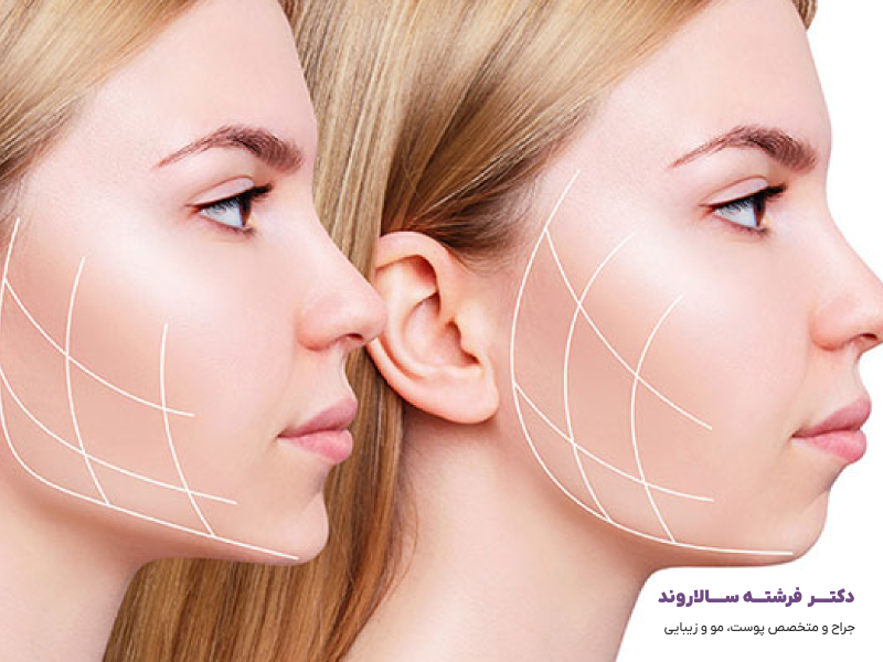 تزریق فیلر چانه - سالاروند