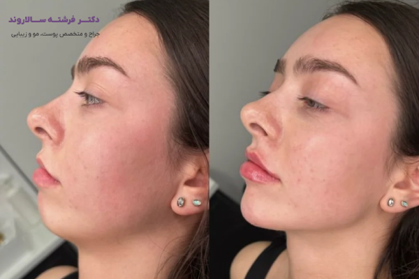 تزریق فیلر چانه چیست و چگونه انجام میشود؟