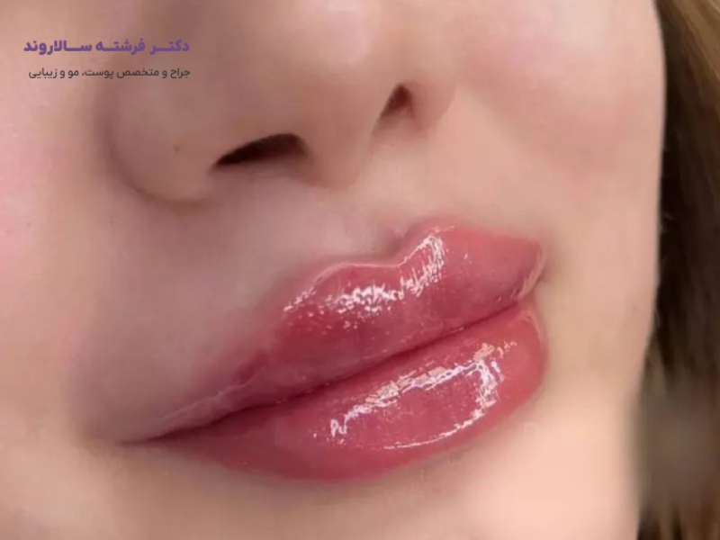 تزریق ژل