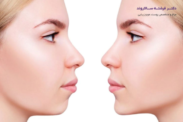 مراحل انجام تزریق فیلر چانه