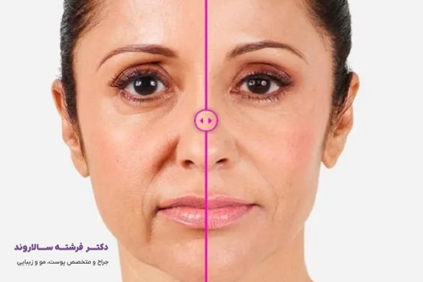 مراحل تزریق فیلر خط خنده