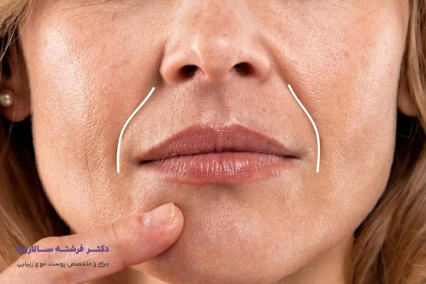 مراقبتهای پس از تزریق فیلر خط لبخند و عوارض اولیه آن