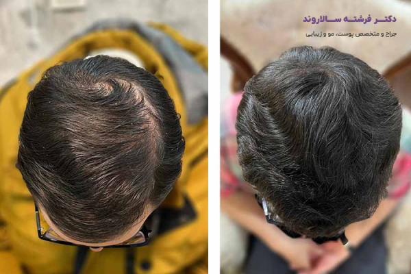مراحل انجام مزوتراپی مو و تعداد جلسات پیشنهادی