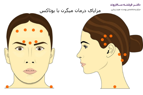 مزایای درمان میگرن با بوتاکس